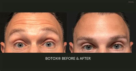 Botox® Basics How Many Units Of Botox Do I Need Dermatology