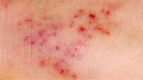 Meningitis Rash