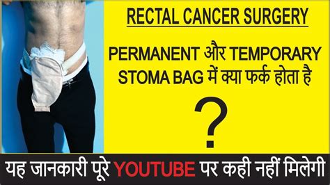 Permanent Colostomy Bag Temporary Colostomy Bag Difference Between