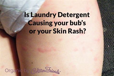 If Laundry Detergent Or Fabric Softener Is Causing Skin Irritation