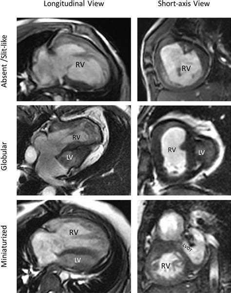 Examples Of Left Ventricular Morphologies Seen On Cardiac Magnetic