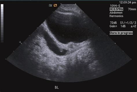 Distal Ureter Ultrasound