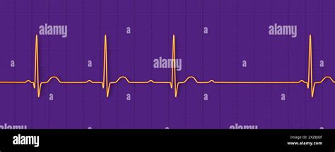 Ecg With Second Degree Av Block Illustration Stock Photo Alamy