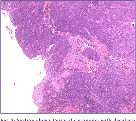 Synchronous Primary Carcinoma Of Cervix And Endometrium Semantic Scholar