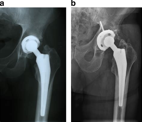 Uncemented Total Hip Arthroplasty With A Tapered Titanium Femoral