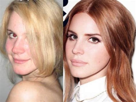 Lana Del Rey Plastic Surgery Before And After Photos