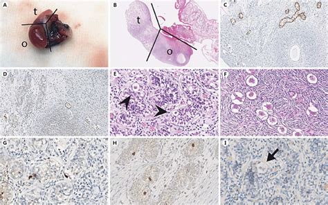 Histology And Immunohistochemistry Of Ovotestis Histologically