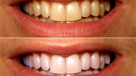 Teeth Whitening And Lightening Treatments