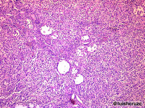 Patolog A Cc Ovario Tumor De C Lulas De La Granulosa Juvenil