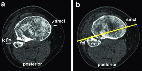 Computed Tomography Of A Tibial Plateau Axial View A And B Are Axial Download Scientific