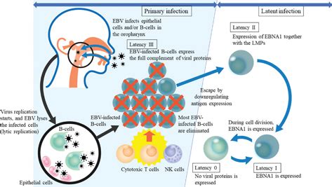 View Of Epstein Barr Virus Positive Diffuse Large B Cell Lymphoma