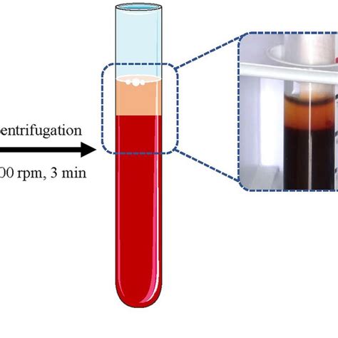 The Preparation Of Injectable Platelet Rich Fibrin After Download