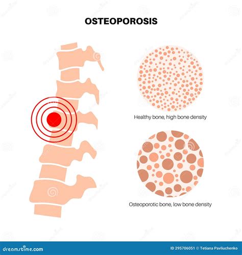 Osteoporosis Medical Poster Stock Vector - Illustration of disease
