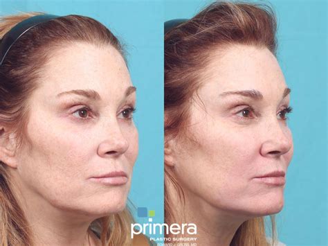 Laser Skin Resurfacing Dot Co Before And After Pictures Case