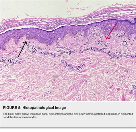 Figure 2 From Bilateral Naevus Of Ito And Ota With Palatal Involvement