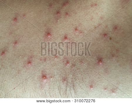 Chicken Pox Rash On Image & Photo (Free Trial) | Bigstock