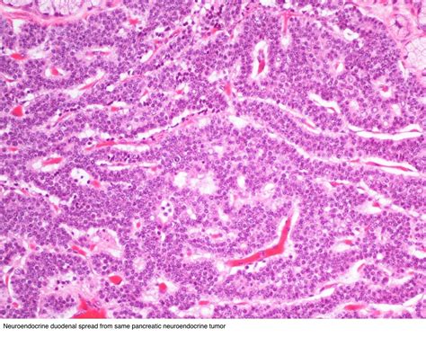 Pathology Outlines Neuroendocrine Neoplasms General