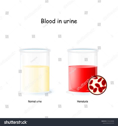 Normal Bloody Urine Two Beaker Urine Stock Vector (Royalty Free) 1594248388