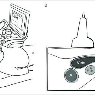 A Under The Real Time Guidance Of Ultrasound US FNA Can Be