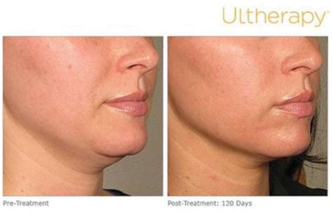 Ultherapy – The Only FDA Approved Non-Surgical Face Lift | IMAGE Magazine