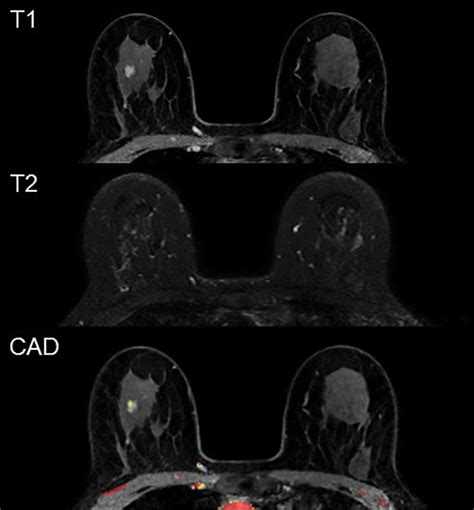 Reducing False-Positives in MRI Breast Cancer Screening