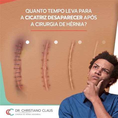 The Best Cirurgia Hernia Inguinal Cicatriz Bemooncoukpics