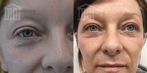 Before After Co Laser Zenith Cosmetic Clinics