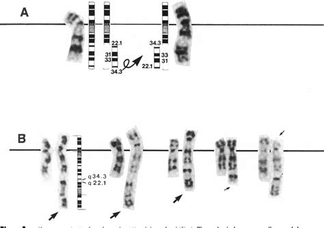 Figure 2 From A Dicentric Recombinant 9 Derived From A Paracentric Inversion Phenotype