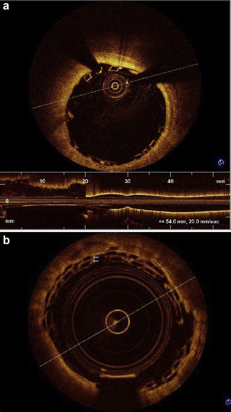 E A Oct Picture Of Well Apposed Bioabsorbable Stent B Overlapping Download Scientific