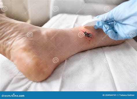 Doctor Treats A Large Healing Wound From A Severe Burn On The Leg Of An