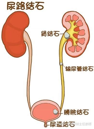 胆结石与肾结石的区别一次说清楚 知乎