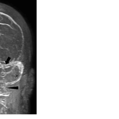 A postcontrast MR venogram of the head showed nonocclusive venous ...