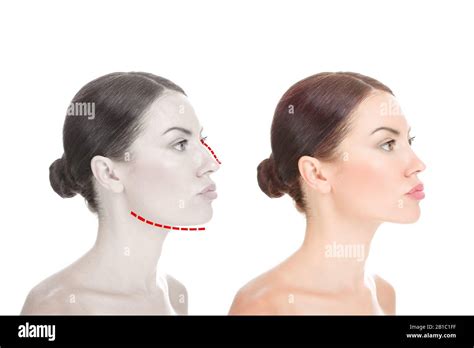 Face Beauty Nose And Chin Correction Rhinoplasty Genioplasty Chin