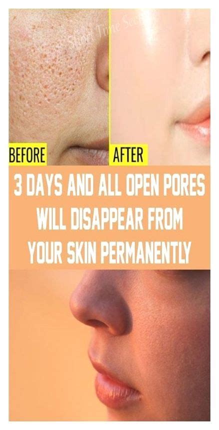 Why Large Pores Appear And How To Get Rid Of Them Artofit