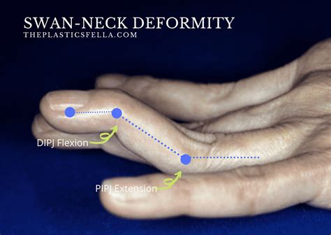 Boutonniere Deformity