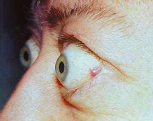 Exophthalmos; Proptosis