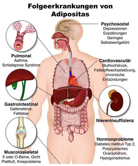 Adipositas Behandlung Und Ursachen Heilpraxis