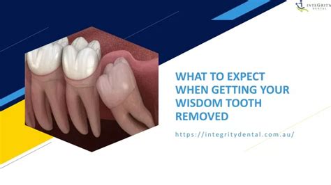 Ppt What To Expect When Getting Your Wisdom Tooth Removed Powerpoint Presentation Id12754422