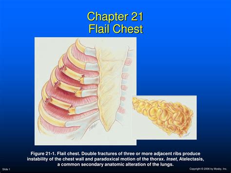 Ppt Chapter 21 Flail Chest Powerpoint Presentation Free Download Id 176187