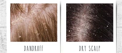 Dandruff Vs Dry Scalp Key Differences Treatment Options