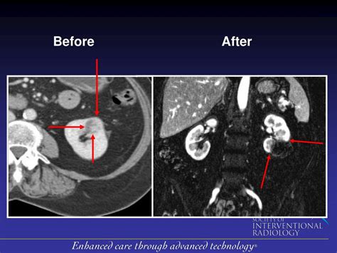 PPT - Cryoablation Minimally-Invasive, Non-Surgical Treatment for ...