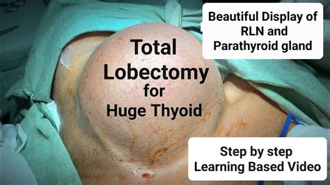 Steps Of Thyroidectomy Thyroid Lobectomy For Huge Thyroid Dr Tayyab