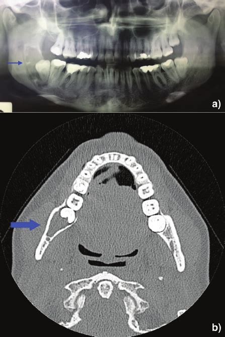 Radiographic Imaging A Orthopantomography Showing A Radiolucent