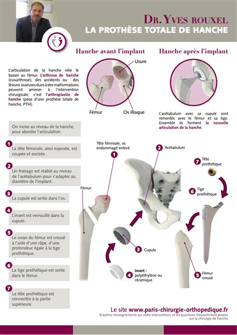 Proth Se Totale De Hanche Dr Yves Rouxel