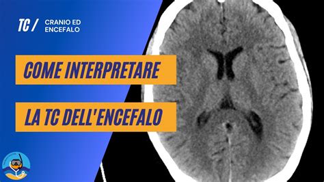 Come Interpretare La TC Encefalo Parte 1 Anatomia YouTube