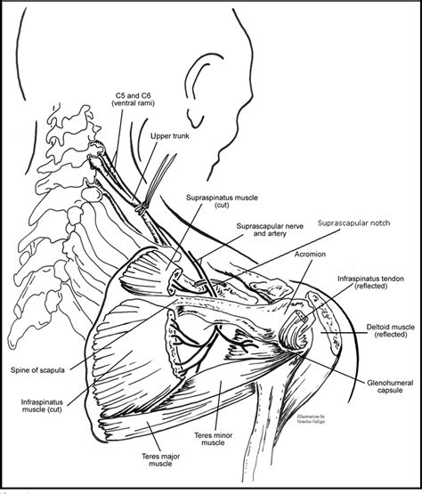 Figure 1 From Diagnosing Suprascapular Neuropathy In Patients With