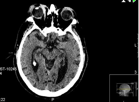 Retrobulbar Hematoma