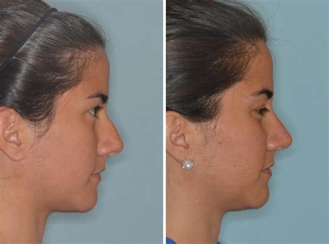 Rhinoplasty Photos Miami Fl Patient 515