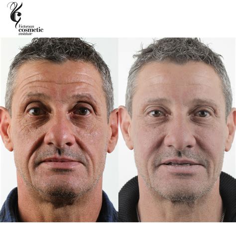 Male Rejuvenation Melbourne Victorian Cosmetic Institute