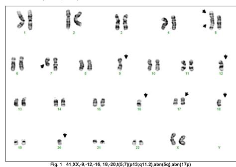 Acute Promyelocytic Leukemia Karyotype